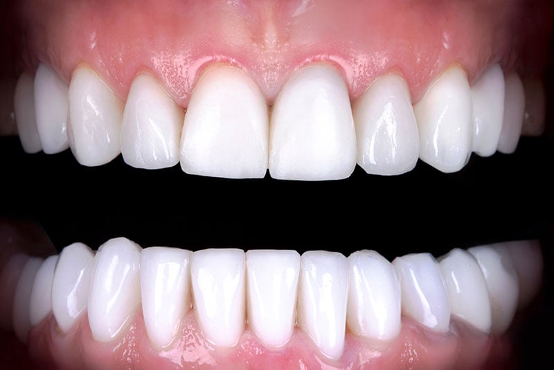 Close up photo of before and after image of a dental procedure