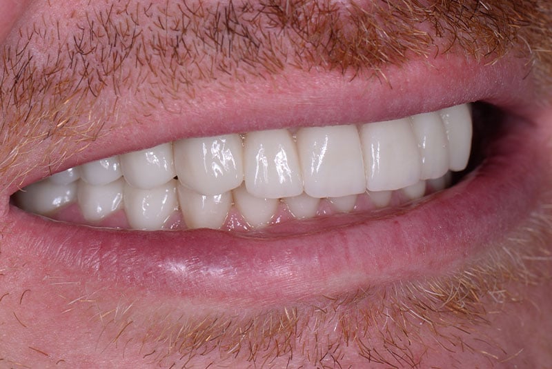 Close up photo of before and after image of a dental procedure