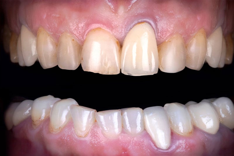Close up photo of before and after image of a dental procedure