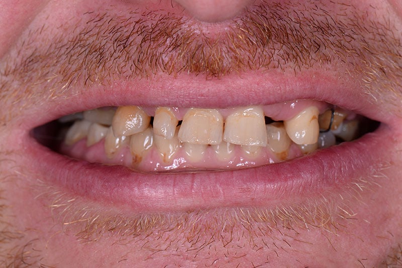 Close up photo of before and after image of a dental procedure
