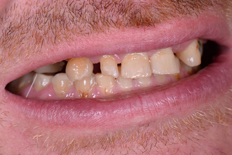 Close up photo of before and after image of a dental procedure