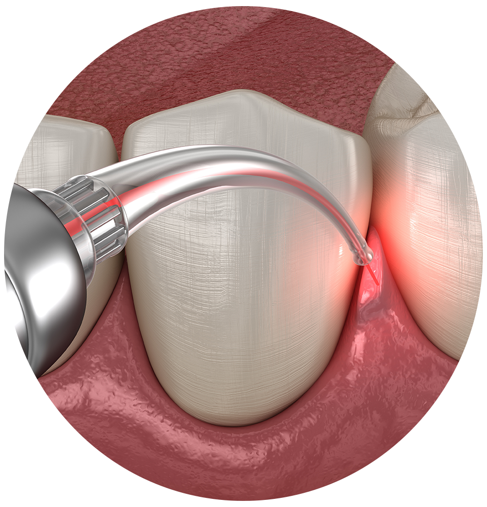 close up of laser periodontics treatment