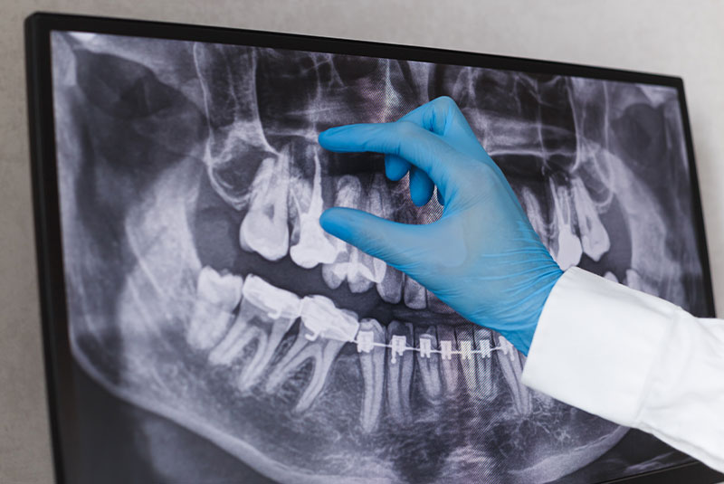close up of doctor examining patients root canal